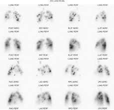 Pulmonary Embolism Diagnosis An Overview Sciencedirect