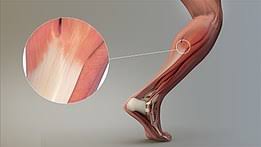 The iliotibial band (itb) is a tendon that runs along the outside of your leg. Tendon Wikipedia