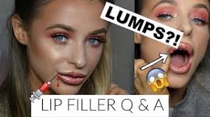 lip filler q a i have a lump on my