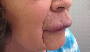 derm dx enlarged and swollen lips