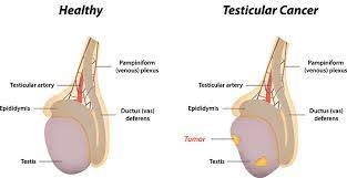 testicular cancer sioux city