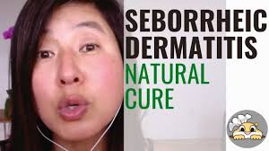treat seborrheic dermais naturally