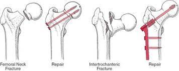 hip fracture treatment las vegas