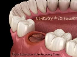 hole to close after a tooth extraction
