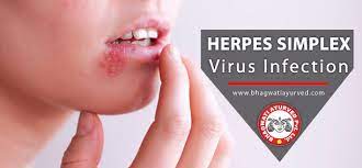 best treatment for herpes bhagwati