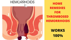 Experience of relief application blagodarnyy l.a. Thrombosed Hemorrhoids Piles How To Get Rid Of Hemorrhoids Hemorrhoids Treatment 2020 Youtube