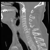 Image result for icd-10 code for c7 fracture