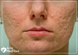 acne without cosmetic procedures
