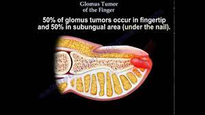 glomus tumor of the finger everything