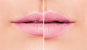 dissolving lip filler a guide to lip