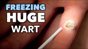 freezing a huge infected wart with