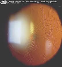 Corneal epithelial basement dystrophy is a disorder of the surface of the eye (epithelium). Atlas Of Ophthalmology