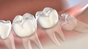 In most cases, the gauze is removed for around 10 minutes. Post Operative Instructions Wisdom Teeth Fresno Clovis Reedley Madera Ca