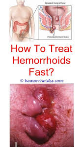 Hemorrhoids are distended blood vessels that form either externally (around the anus) or internally (in the lower rectum). Pin On Icd 10 Code For Hemorrhoids