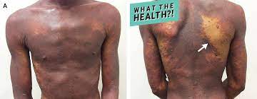 hiv rash what it is and what causes it