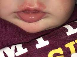 drooling rash babycenter