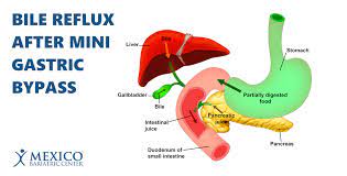 bile reflux after mini gastric byp