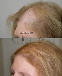 nyc female hair loss treatment new