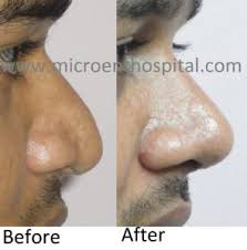 rhinoplasty cost in hyderabad nose