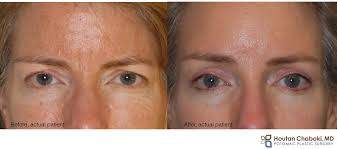 upper eyelid with plastic surgery