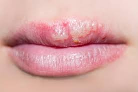 Infections are categorized based on the part of the body infected. Herpes Mund Lippen Genitalbereich Gesundheit De