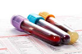 Gli esami del sangue sono l'esame più semplice ed immediato per conoscere lo stato di salute del nostro corpo. Tumore Addio Ecco Le Analisi Del Sangue Salva Vita Attenti Ai Valori Spia Come Fare Piu Donna