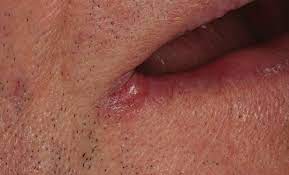 red ed sore corners of the mouth