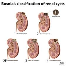 Diagram Bosniak Classification Of Renal Cysts Radiology