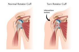 rotator cuff tear symptoms repair