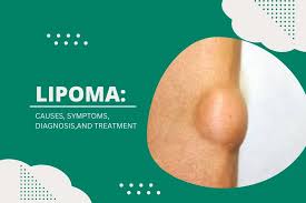 lipoma causes symptoms diagnosis