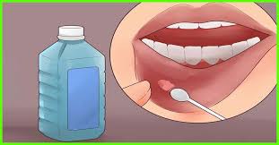 home remes for mouth ulcer 15