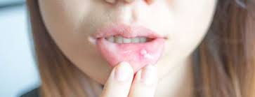 what causes mouth ulcers conditions