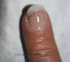 chapter 9 nail disorders and diseases