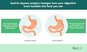 gastric byp reversal what happens