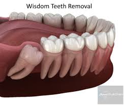 wisdom teeth removal surgery for