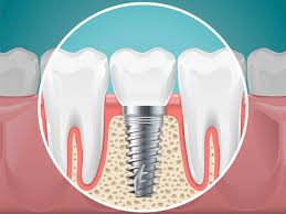 Benefits of Dental Implants • Summit Dental Group
