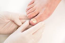 fungal nails gray foot and orthotic