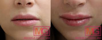 the best lip fillers in nyc before and