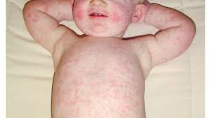 baby rash causes types treatments