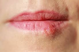 cold sores vs herpes differences