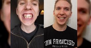 Have at least a moderate need for braces; 15 Drastic Transformations Of People Before And After Braces