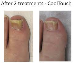 toe nail fungus treatment baltimore md