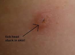 remove a tick head stuck in your skin