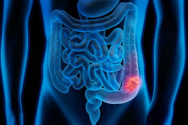 For other uses, see colon. Strange Colon Discovery Explains Racial Disparities In Colorectal Cancer Uva Today