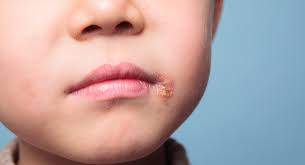 cold sores in toddlers and preers