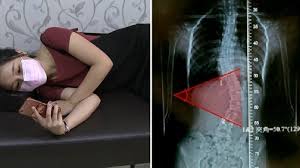 Sakit punggung dapat menyerang punggung bagian bawah, bagian tengah dan atas. Sakit Tulang Belakang Bawah Penyebab Dan Cara Mengatasinya Tribun Kaltim