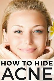 how to hide blemishes acne