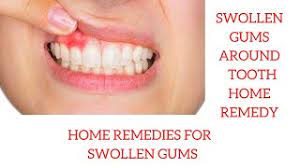 14 home remes for swollen gums and