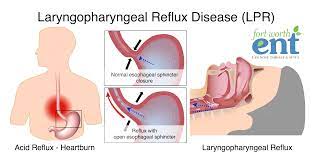 laryngopharyngeal reflux disease lpr