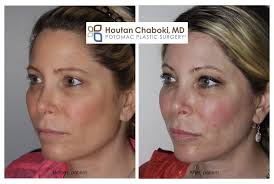 According to the american society of plastic surgeons, 2.7 million facial. Reducing Swelling After Injectable Fillers In Dc Dr Houtan Chaboki